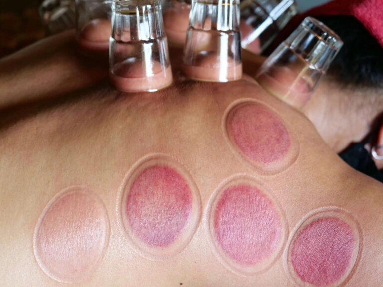 Picture showing the Quoimai-Thai-Cupping procedure